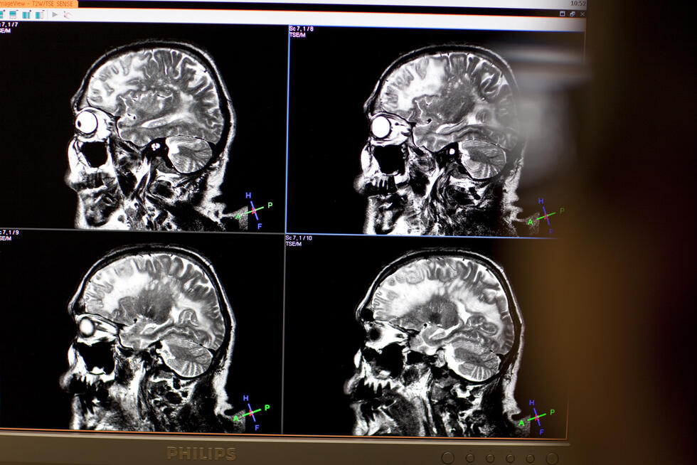 an x-ray image of a brain (symbol image)